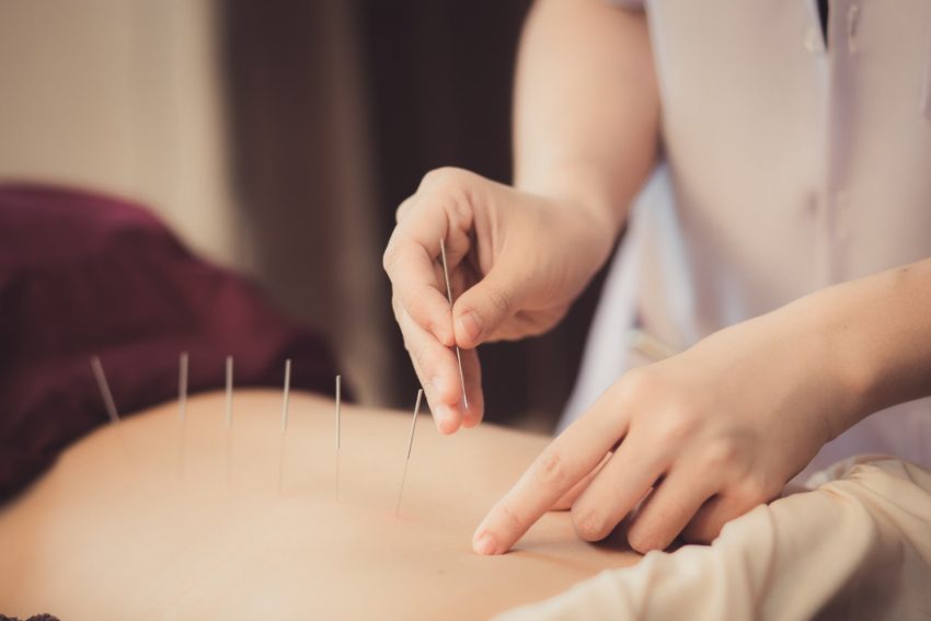 Acupuncture - P1500+